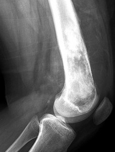 osteosarcoma